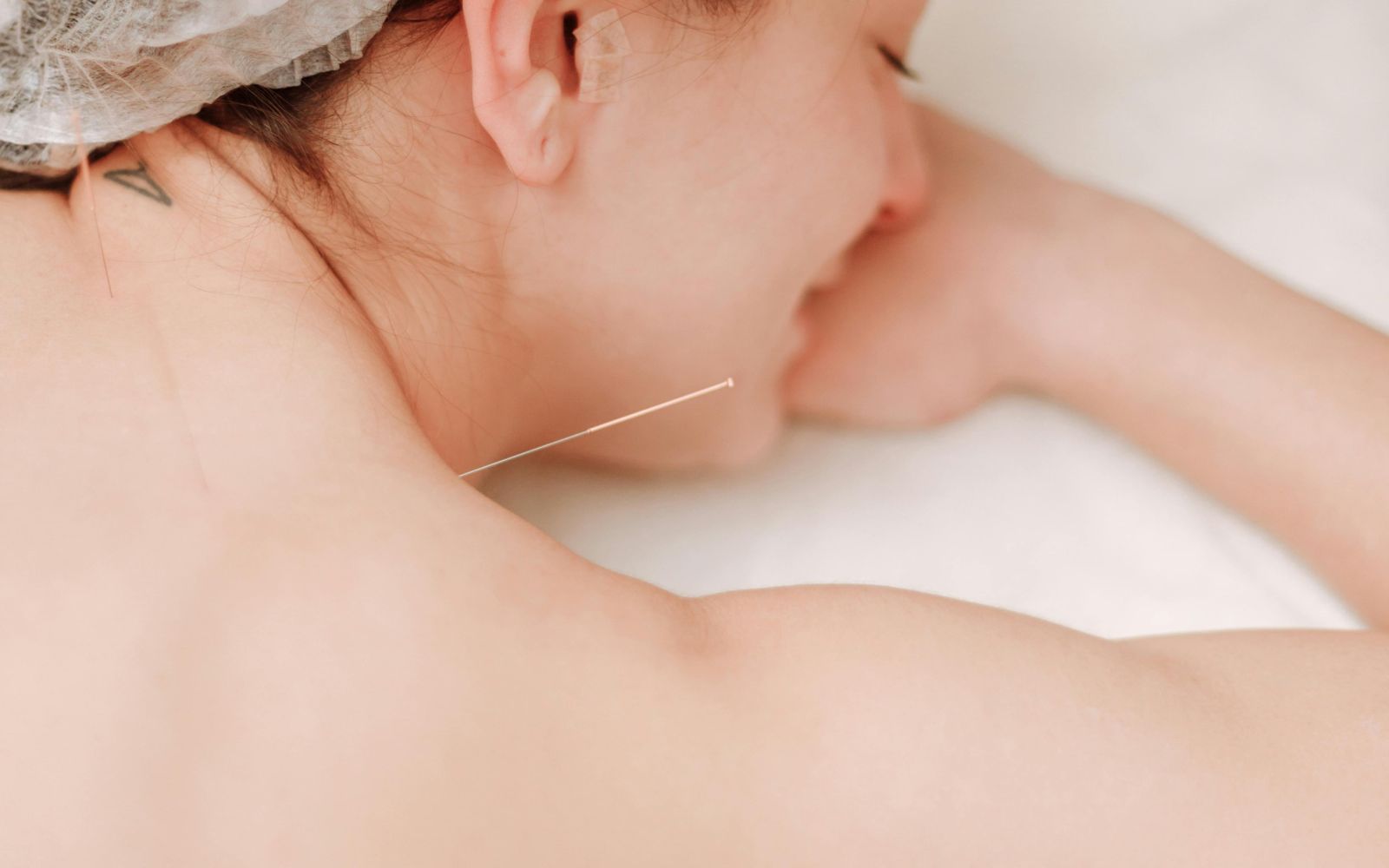 dry needling